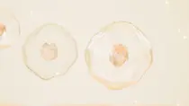 처진 턱선 리프팅, HIFU와 충격파 중 무엇이 맞을까?