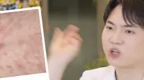 스킨바이브, 볼 꺼짐을 채우는 필러와 같을까요?