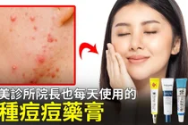 藥局痘痘藥膏4款，先看成分再談痘印管理