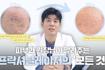 痘疤毛孔激光，先分清飞梭雷射方式
