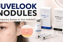 Juvelook Nodules: When a Post-Treatment Lump Needs Attention